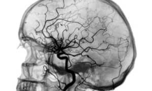 Как проводится ангиография сосудов головного мозга