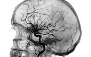 Как проводится ангиография сосудов головного мозга