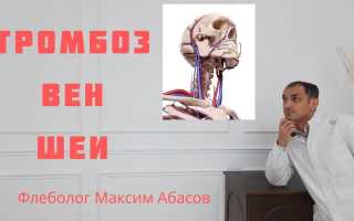 Тромбоз яремной вены — причины, симптомы и лечение