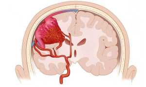 Ангиома сосудов головного мозга