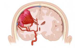 Ангиома сосудов головного мозга