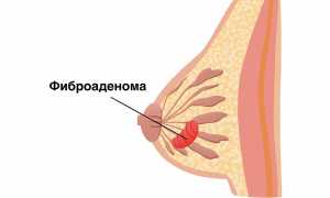 Аденома грудной железы у женщин: все, что нужно знать
