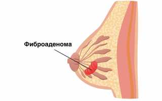 Аденома грудной железы у женщин: все, что нужно знать