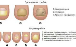 Лечение грибка ногтей лаком: обзор самых эффективных средств