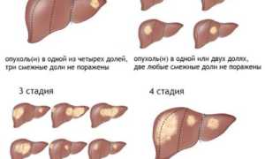 Причины возникновения гемангиомы в печени