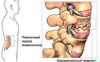 Компрессионный перелом 3 позвонка поясничного отдела — причины, симптомы и лечение