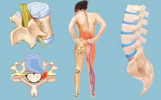 Греем грыжу на поясничном отделе позвоночника — безопасно ли?