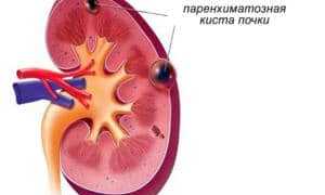 Симптомы и лечение паренхиматозной кисты почки