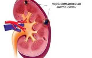 Симптомы и лечение паренхиматозной кисты почки