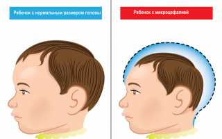 Что такое олигофрения: выявляем симптомы и особенности