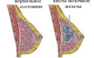 Как лечить кисту молочных желез