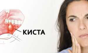 Симптомы и лечение кисты во рту