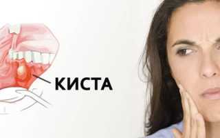 Симптомы и лечение кисты во рту