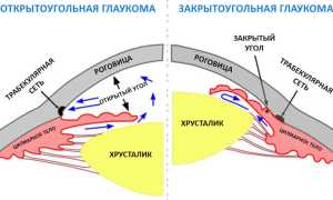 Закрытоугольная глаукома: что это такое и как с ней бороться