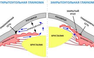 Закрытоугольная глаукома: что это такое и как с ней бороться