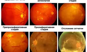 Что такое ангиоспазм сетчатки глаза и как его распознать