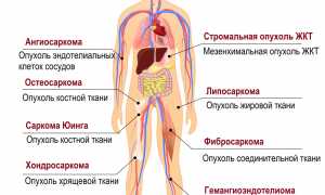 Саркома позвоночника: что это такое и как с этим бороться?