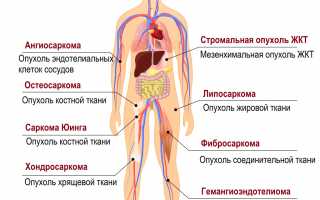 Саркома позвоночника: что это такое и как с этим бороться?