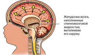 Причины водянки мозга у взрослого и методы лечения