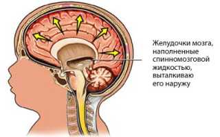 Причины водянки мозга у взрослого и методы лечения