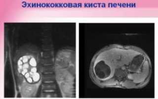 Эхинококковая киста печени