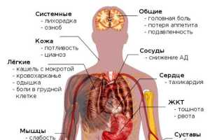 Левосторонняя пневмония — причины, симптомы и лечение