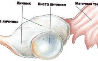 Чем опасны кисты на яичниках у женщин