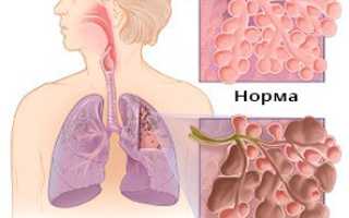 Последствия фиброза легких и способы его лечения