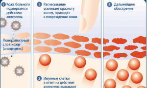 Почему появляется аллергия у грудного ребенка на лице и чем лечить?