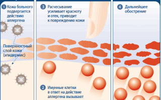 Почему появляется аллергия у грудного ребенка на лице и чем лечить?