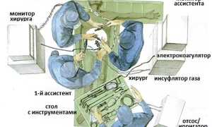 Меры подготовки к лапароскопии кисты яичника