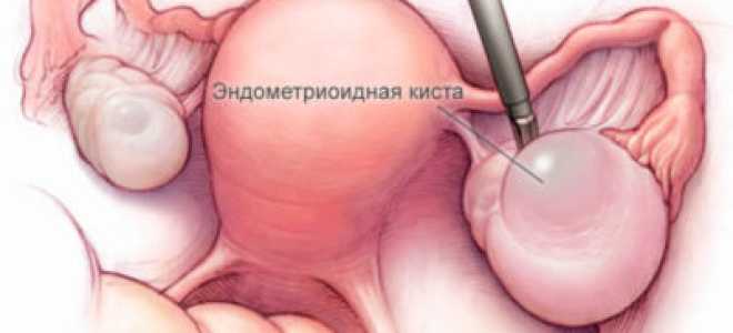 Симптомы и лечение эндометриоидной кисты яичника