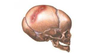 Перелом костей свода и основания черепа
