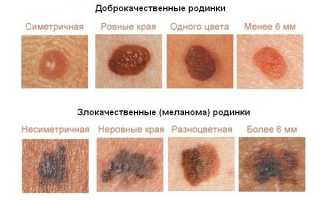 К какому врачу обратиться с родинками для удаления и обследования?