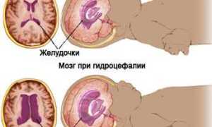 Симптомы и лечение гидроцефалии у ребенка