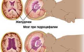 Симптомы и лечение гидроцефалии у ребенка