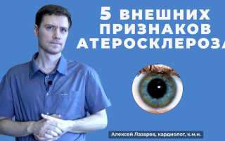 Атеросклероз аорты — основные признаки и симптомы