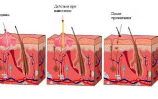 Карандаш ляписный: инструкция по применению и отзывы