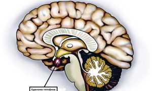 Новообразование головного мозга: аденома гипофиза