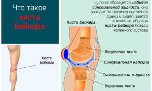 Симптомы и лечение кисты Бейкера коленного сустава
