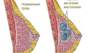 Формы и признаки фиброзно-кистозной мастопатии