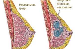 Формы и признаки фиброзно-кистозной мастопатии