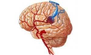 Сосудистые мальформации головного мозга