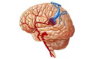 Сосудистые мальформации головного мозга