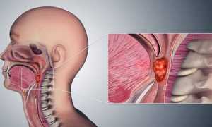 Что такое карцинома носоглотки: понимание, диагностика и лечение