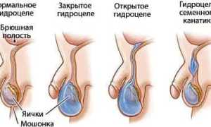 Причины водянки яичка у ребенка и методы лечения заболевания
