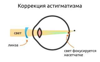 Что такое патология рефракции глаза и как она влияет на наше зрение?