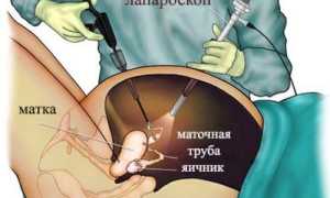 Все про лапароскопию кисты яичника