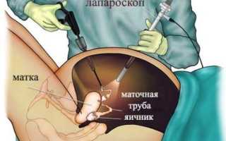 Все про лапароскопию кисты яичника