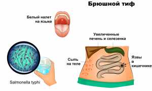 Паратифы: что это за болезнь и как ее распознать?